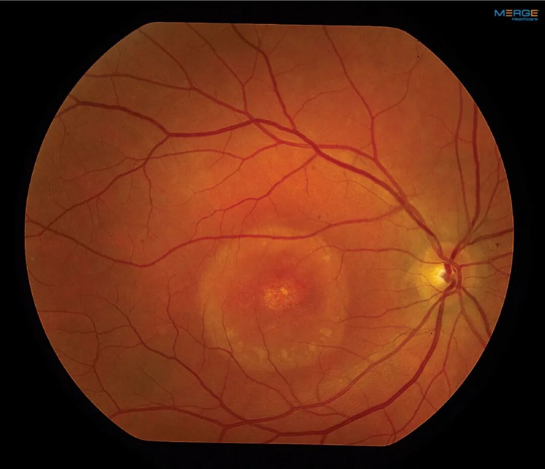 Vitelliform Lesions Reported in Peripapillary Pachychoroid Syndrome