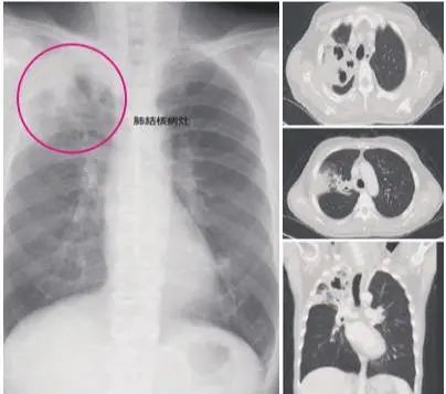 肺结核具有极强的传染性，若发现人有这6个表现，要注意避让预防-图4