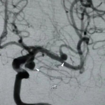 一次显微手术，拆除3枚“炸弹” ！盐城市一院神经外科成功开展左侧眶上外侧入路颅内多发动脉瘤夹闭术