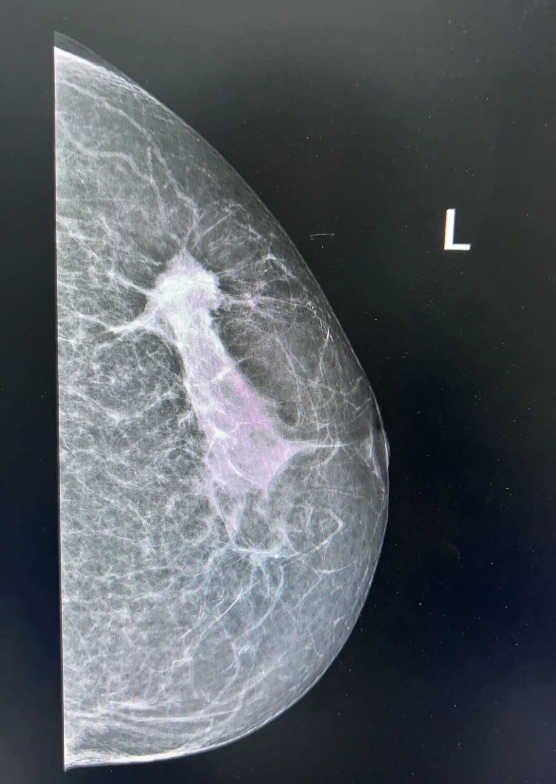 乳腺机为什么叫钼靶【科普】乳腺钼靶知多少？_https://www.jmylbn.com_新闻资讯_第5张