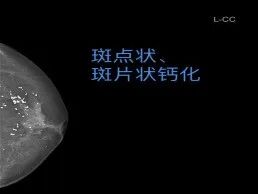 乳腺机为什么叫钼靶【科普】乳腺钼靶知多少？_https://www.jmylbn.com_新闻资讯_第4张