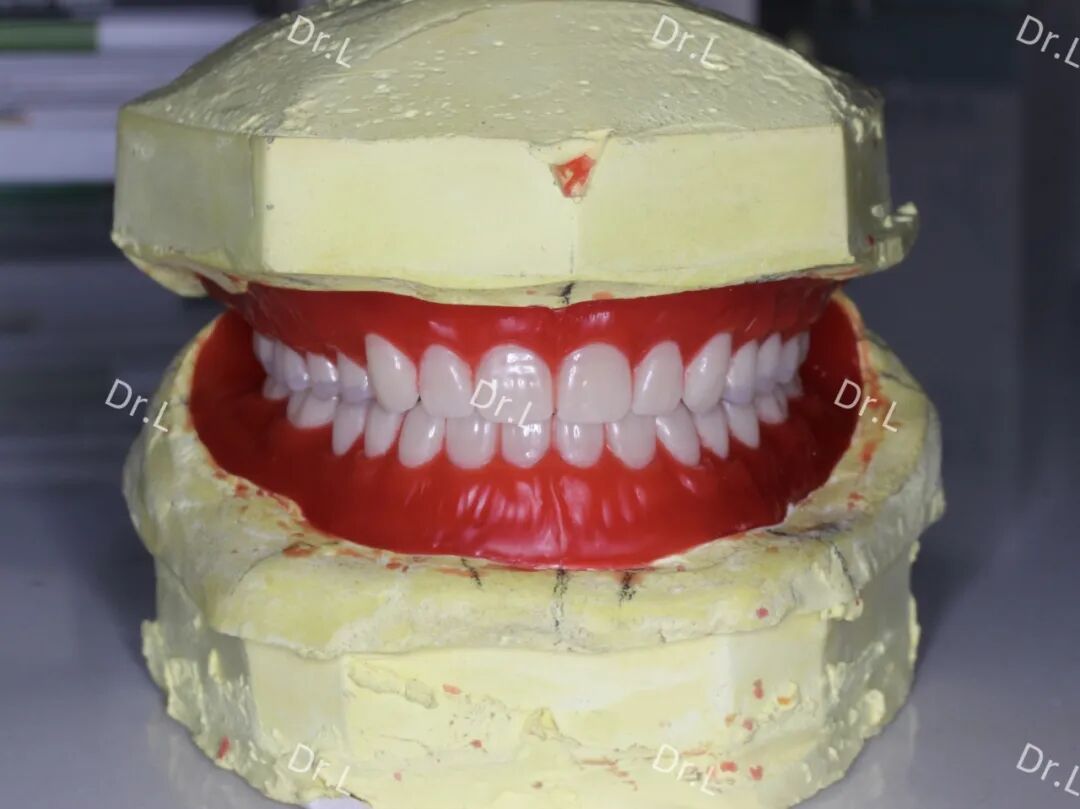 口腔吸盘怎么安装上午取模，下午戴牙，像“吸盘”一样的吸附性义齿来啦！_https://www.jmylbn.com_新闻资讯_第11张