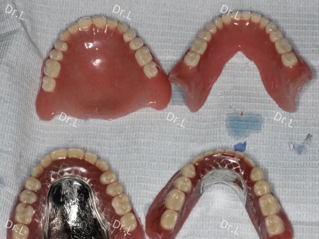 口腔吸盘怎么安装上午取模，下午戴牙，像“吸盘”一样的吸附性义齿来啦！_https://www.jmylbn.com_新闻资讯_第13张