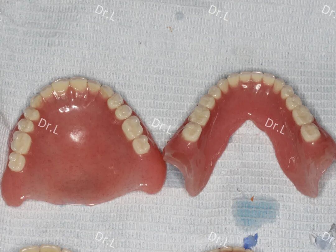 口腔吸盘怎么安装上午取模，下午戴牙，像“吸盘”一样的吸附性义齿来啦！_https://www.jmylbn.com_新闻资讯_第12张