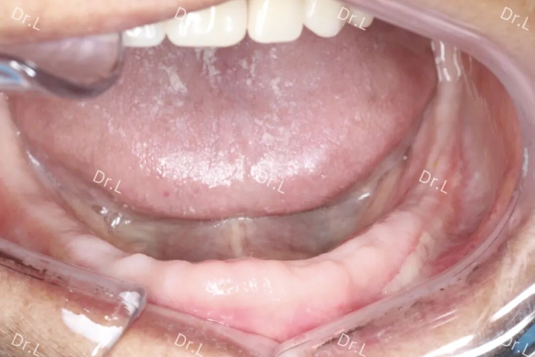 口腔吸盘怎么安装上午取模，下午戴牙，像“吸盘”一样的吸附性义齿来啦！_https://www.jmylbn.com_新闻资讯_第8张