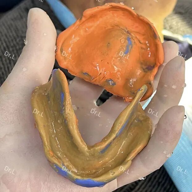 口腔吸盘怎么安装上午取模，下午戴牙，像“吸盘”一样的吸附性义齿来啦！_https://www.jmylbn.com_新闻资讯_第9张