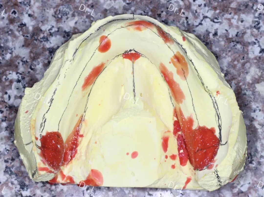 口腔吸盘怎么安装上午取模，下午戴牙，像“吸盘”一样的吸附性义齿来啦！_https://www.jmylbn.com_新闻资讯_第10张