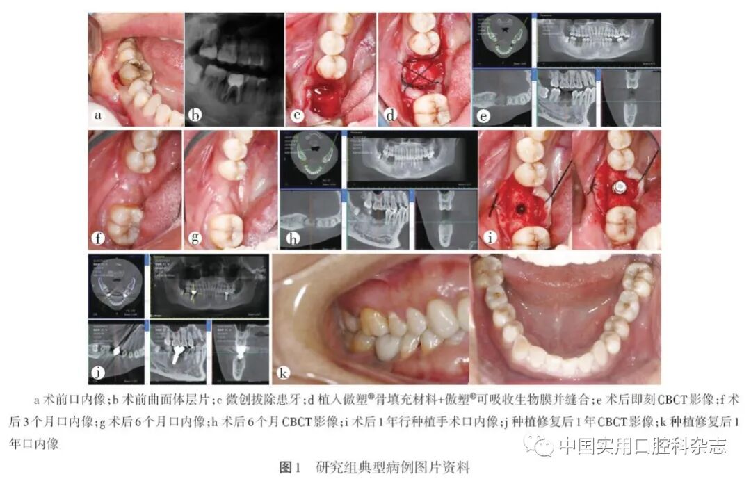 什么是口腔修复膜专栏 ｜ 复合透明质酸钠可塑型骨修复材料及天然生物膜用于牙槽骨缺损修复的临床效果研究_https://www.jmylbn.com_新闻资讯_第6张