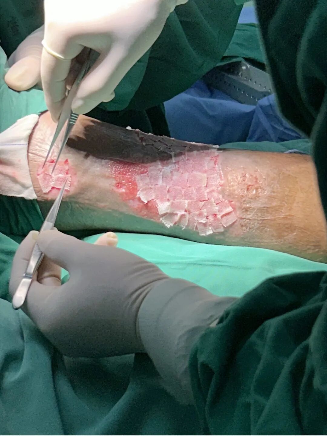 什么是vsd负压引流负压封闭引流术（VSD）：溃疡皮肤重生的福音_https://www.jmylbn.com_新闻资讯_第6张