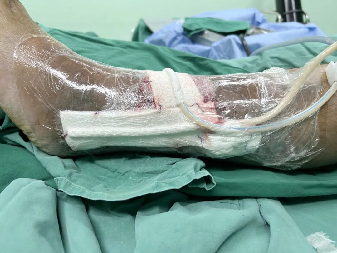 什么是vsd负压引流负压封闭引流术（VSD）：溃疡皮肤重生的福音_https://www.jmylbn.com_新闻资讯_第4张