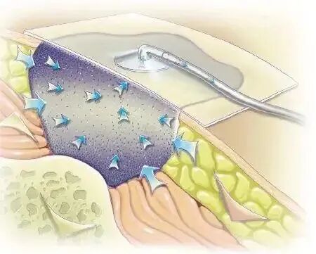 什么是vsd负压引流负压封闭引流术（VSD）：溃疡皮肤重生的福音_https://www.jmylbn.com_新闻资讯_第9张