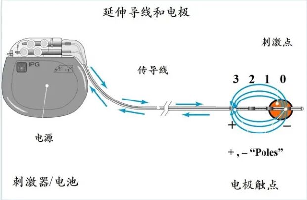 什么是手术电极我院成功开展东北首例微创穿刺电极永久植入手术 治疗脑出血后慢性意识障碍效果良好_https://www.jmylbn.com_新闻资讯_第4张