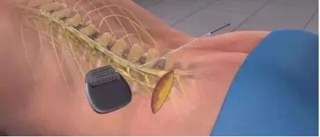 什么是手术电极我院成功开展东北首例微创穿刺电极永久植入手术 治疗脑出血后慢性意识障碍效果良好_https://www.jmylbn.com_新闻资讯_第5张