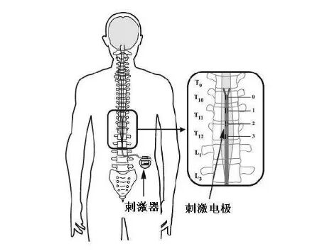 什么是手术电极我院成功开展东北首例微创穿刺电极永久植入手术 治疗脑出血后慢性意识障碍效果良好_https://www.jmylbn.com_新闻资讯_第3张
