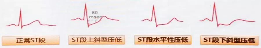 如何处理心绞痛？救治措施全解析！