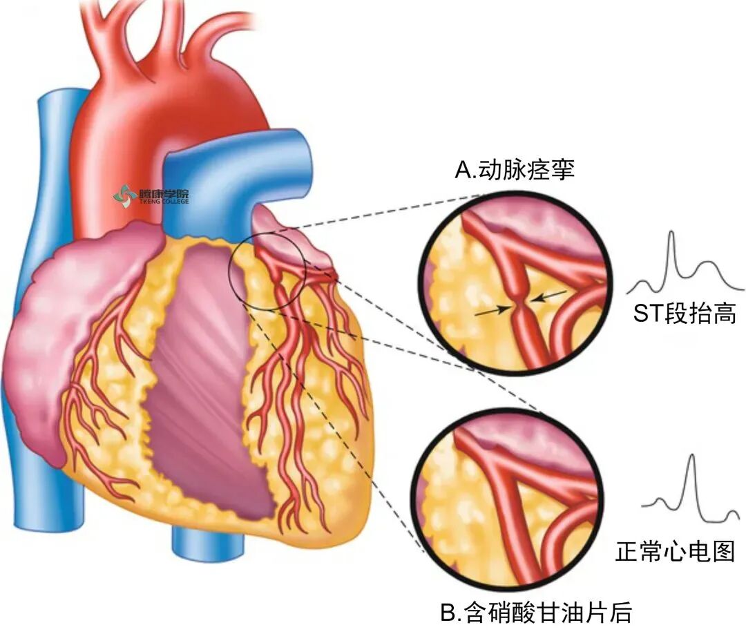 如何处理心绞痛？救治措施全解析！