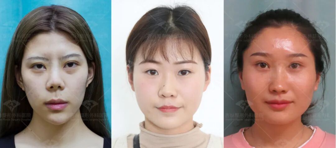 再凹的側臉也能變神顏——杏林改臉型