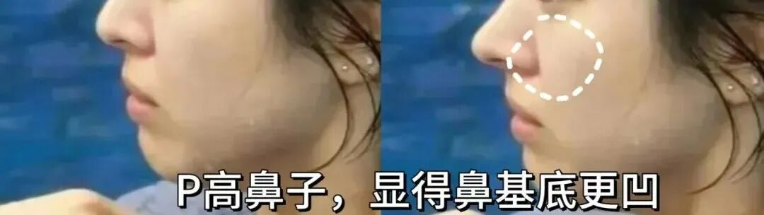 再凹的側臉也能變神顏——杏林改臉型