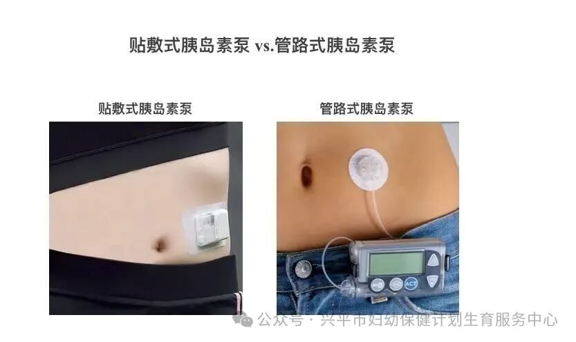 为什么要用泵打针胰岛素泵——“甜蜜杀手”的克星_https://www.jmylbn.com_新闻资讯_第14张