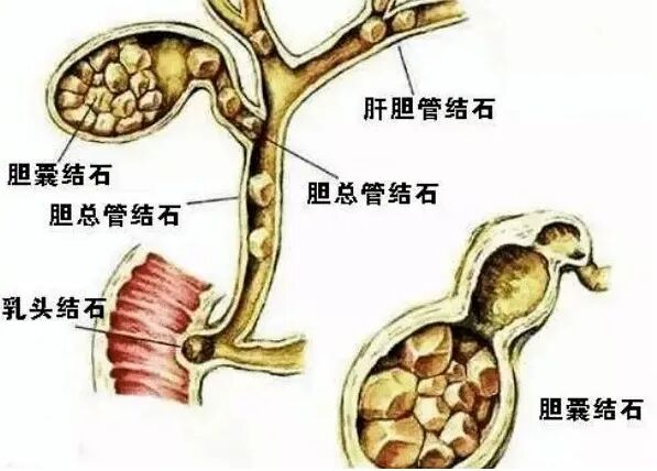 胆囊结石速效方