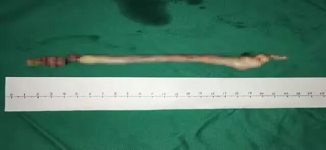 肌瘤钻怎么写罕见！子宫肿瘤钻进心脏，22厘米……_https://www.jmylbn.com_新闻资讯_第2张