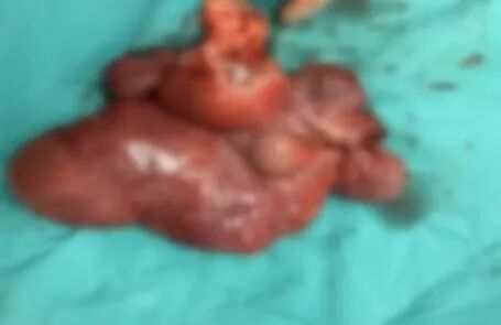 肌瘤钻怎么写罕见！子宫肿瘤钻进心脏，22厘米……_https://www.jmylbn.com_新闻资讯_第6张