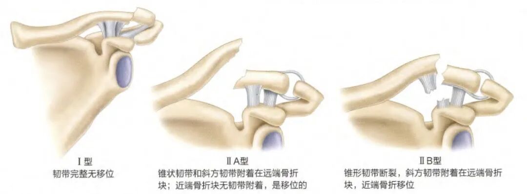 锁骨骨折：从分型到治疗的超全讲解，一文搞定！