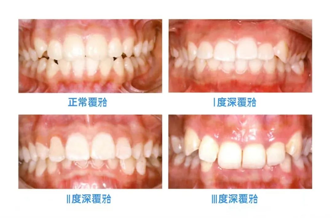 深覆颌是什么？不矫正有危害吗？