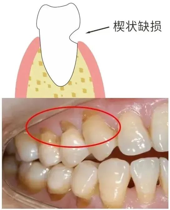 牙齿楔状缺损牙齿酸图片