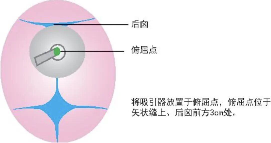kielland产钳怎么翻译阴道助产前的全面评估与方法_https://www.jmylbn.com_新闻资讯_第6张