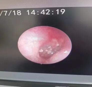 微波治疗是怎么治疗的耳鼻喉科——微波治疗_https://www.jmylbn.com_新闻资讯_第2张