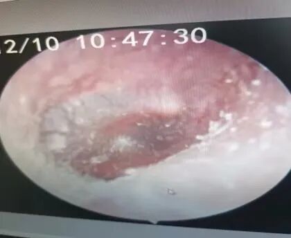 微波治疗是怎么治疗的耳鼻喉科——微波治疗_https://www.jmylbn.com_新闻资讯_第4张