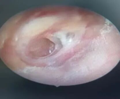 微波治疗是怎么治疗的耳鼻喉科——微波治疗_https://www.jmylbn.com_新闻资讯_第3张