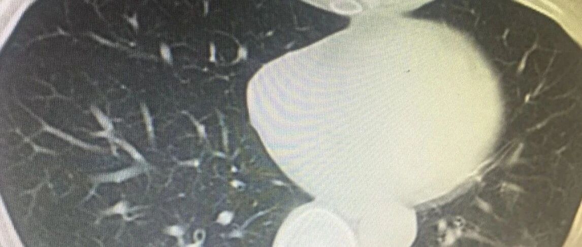 肺CT提示：肺轻度间质性改变是什么意思？该怎么办？