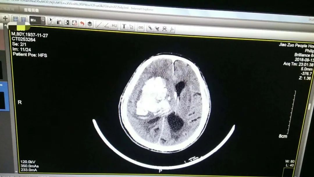 高血壓為什麼會有那麼多並發症？ 健康 第4張