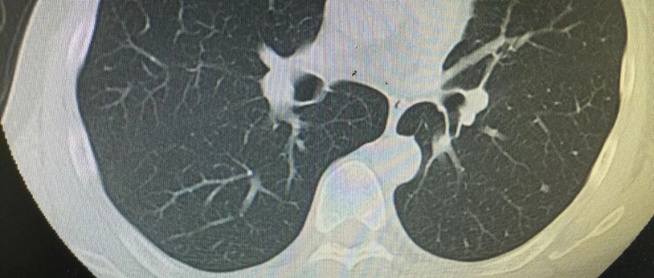 肺微小结节的危害有多大？