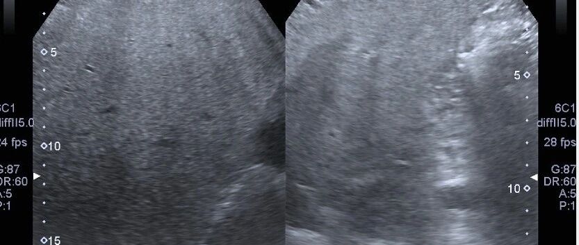 适合脂肪肝患者的运动有哪些？