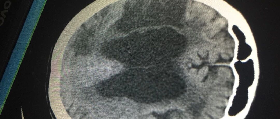 40多岁为什么会得脑梗死？