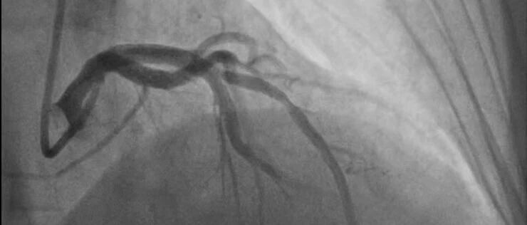 得了冠心病怎么办？会死吗？