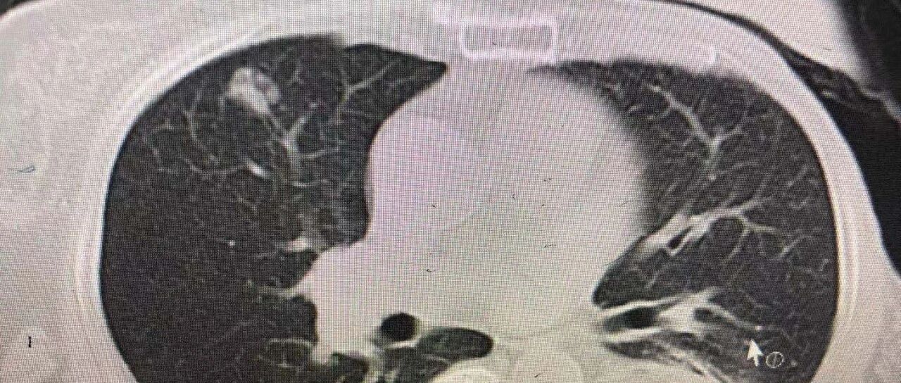 肺结节可以通过吃药消除吗？