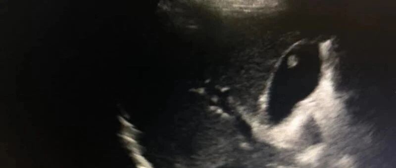 体检发现胆囊壁毛糙，是怎么回事？