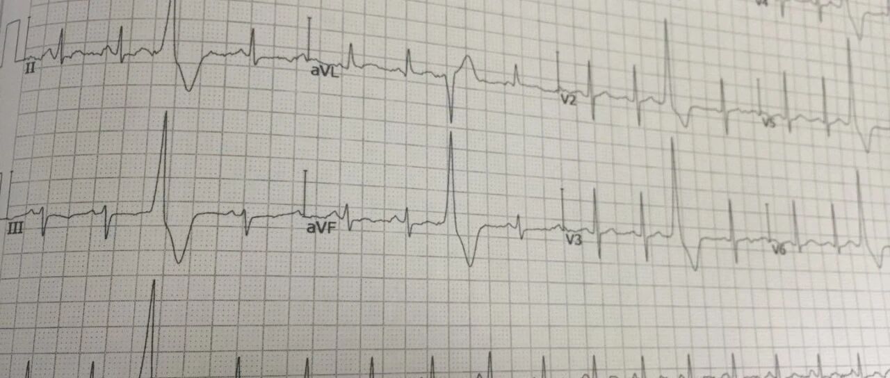 哪些室早提示预后不佳需要积极治疗？