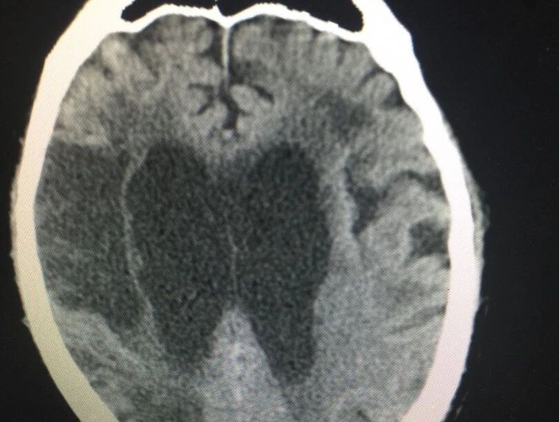 总是担心自己会得心梗、脑梗，该怎么办？