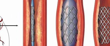 急性心肌梗死，除了支架还有别的治疗方法吗？