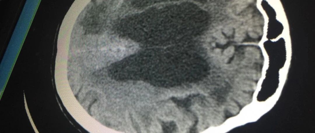 哪些脑梗死患者容易再次复发？该如何预防？