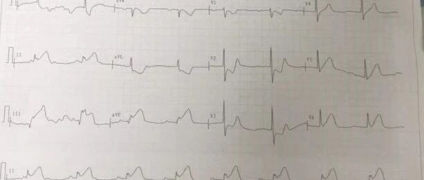 心梗患者要不要放支架？心脏支架有什么利弊？