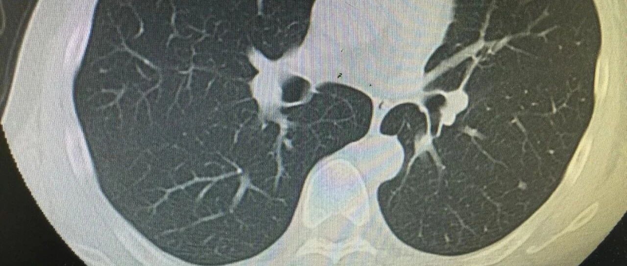 肺小结节的检出率有多高？该怎么避免？