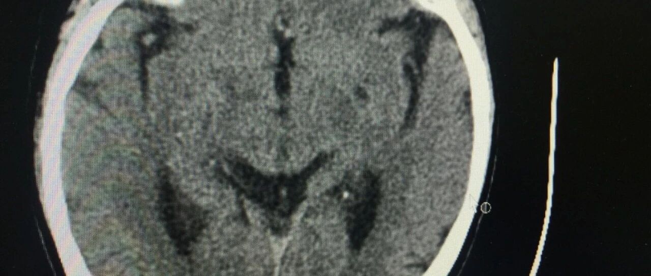 腔隙性脑梗怎么治疗？