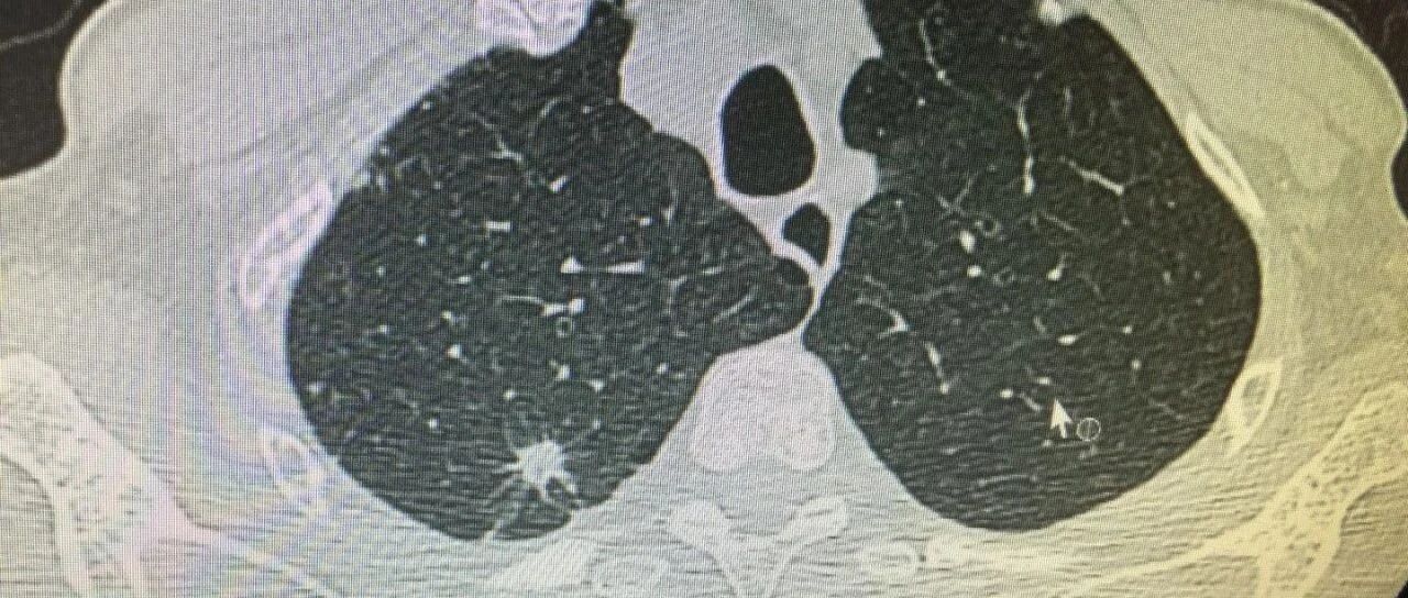 正常人有肺结节吗？肺结节对人体危害有多大？