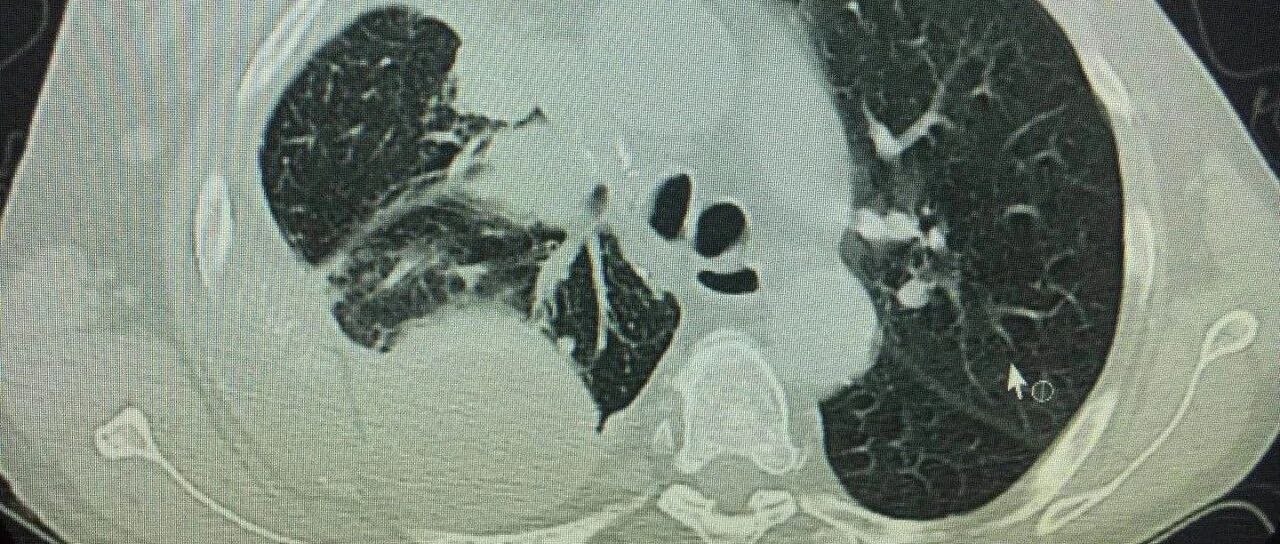 肺部CT检查可以每年做一次吗？